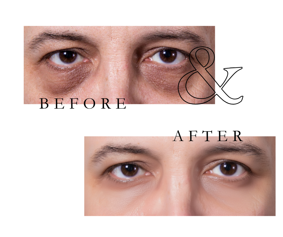 Avenelle Luxe Revitéa™ EMS Eye Massager – Red Light & Gentle Microcurrent Skincare Device